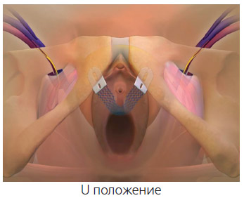 Способы установки системы GYNECARE TVT-Secur*