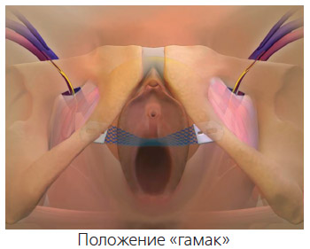 Способы установки системы GYNECARE TVT-Secur*
