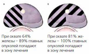 Фокальная терапия РПЖ