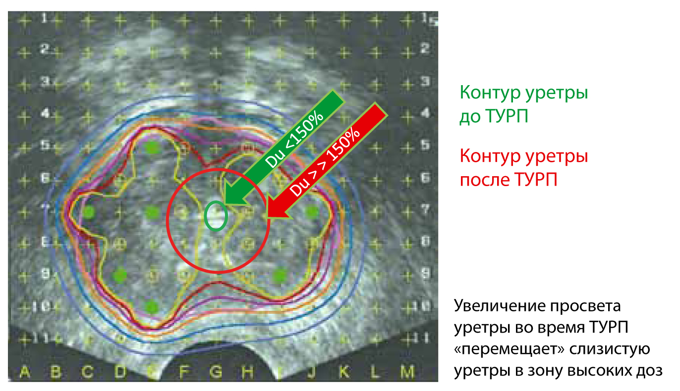 Поверхностный уретральный некроз и трансуретральная резекция