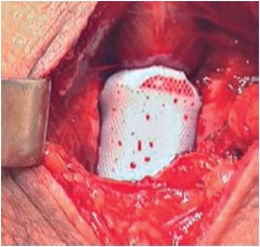 Рисунок 3. Положение «подушечки» слинга Argus после его установки Положение «подушечки» слинга Argus после его установки